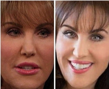 A before and after picture of Robin McGraw's changing nose.